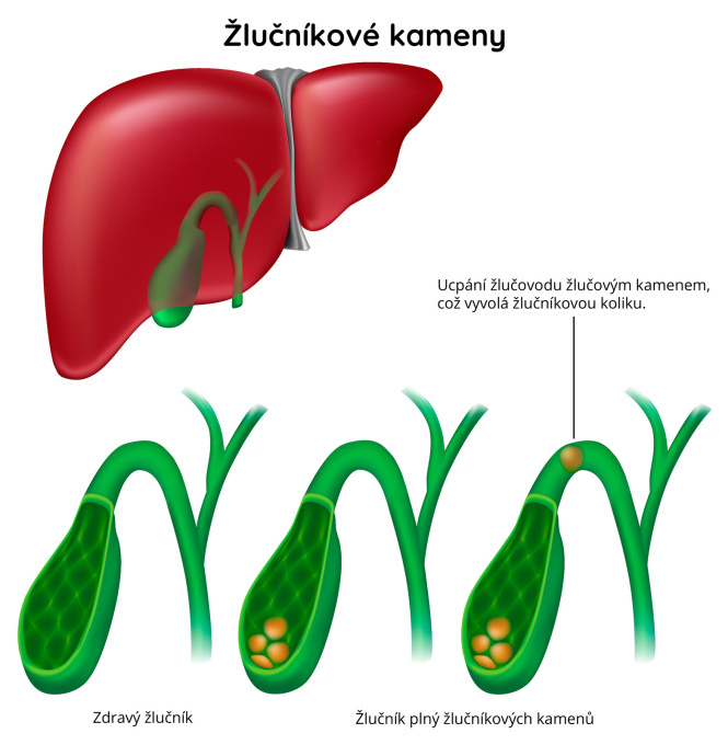 Žlučníkové kameny