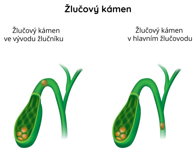 Žlučové kameny