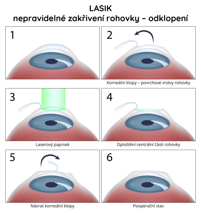 Operace LASIK