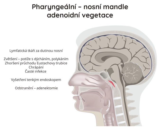 Pharyngeální (nosní mandle) adenoidní vegetace