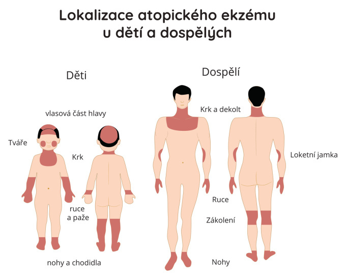 Lokalizace atopického ekzému u dětí a dospělých