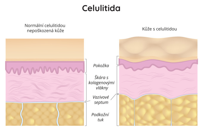 Kůže s celulitidou
