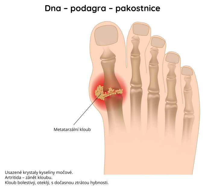 Dna, podagra, pakostnice
