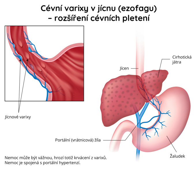 Cévní varixy v jícnu (ezofagu) – rozšíření cévních pletení
