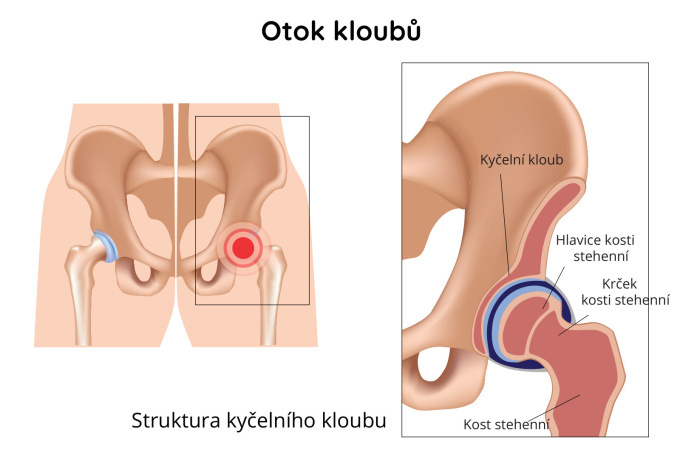 Otok kyčelního kloubu