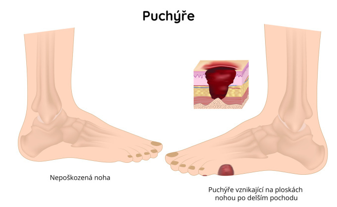 Puchýře na nohou