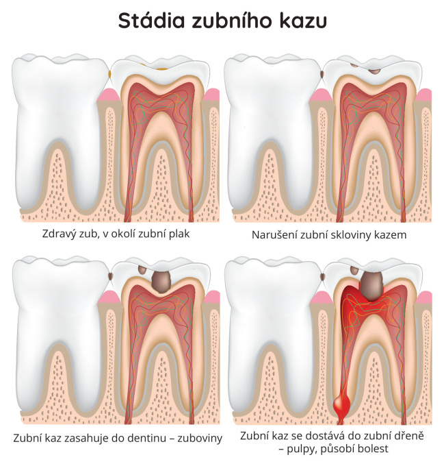 Stádia zubního kazu