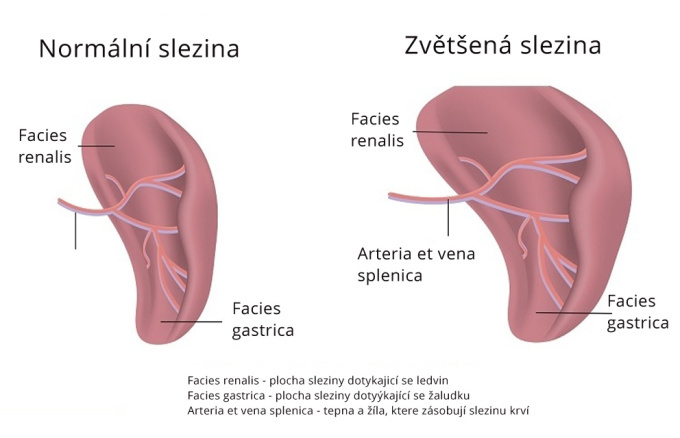 Splenomegalie - zvětšená slezina