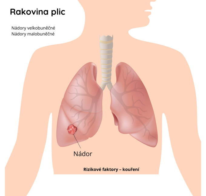 Rakovina plic