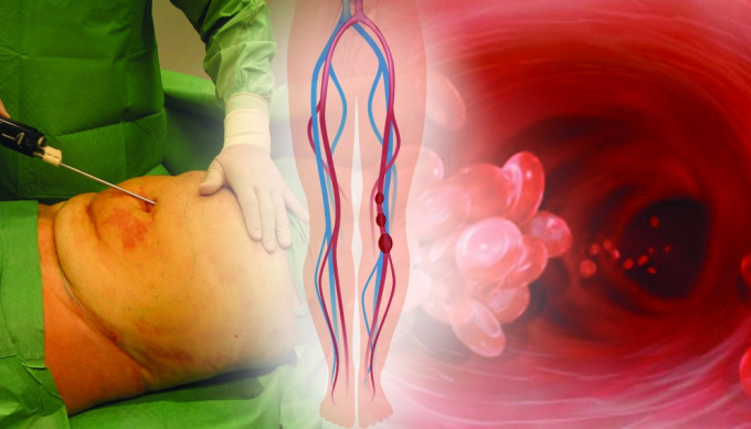 Liposukce