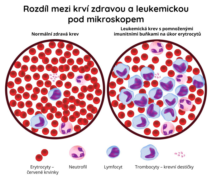 Rozdíl mezi krví zdravou a leukemickou pod mikroskopem