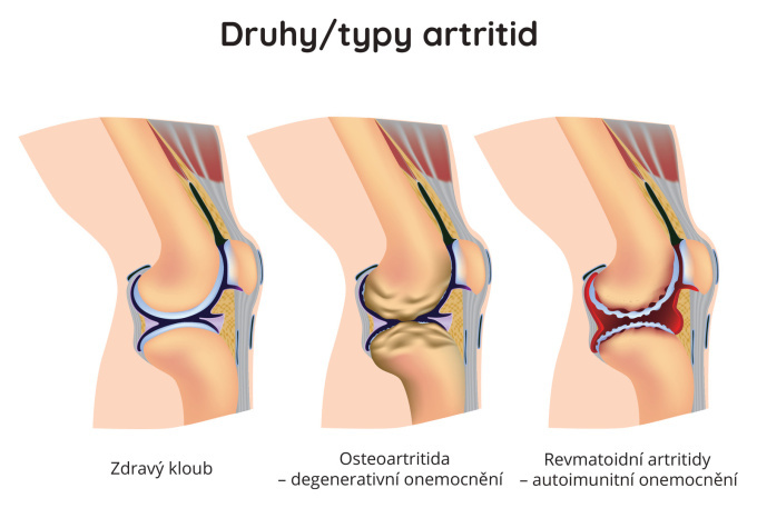 Druhy-typy artritid