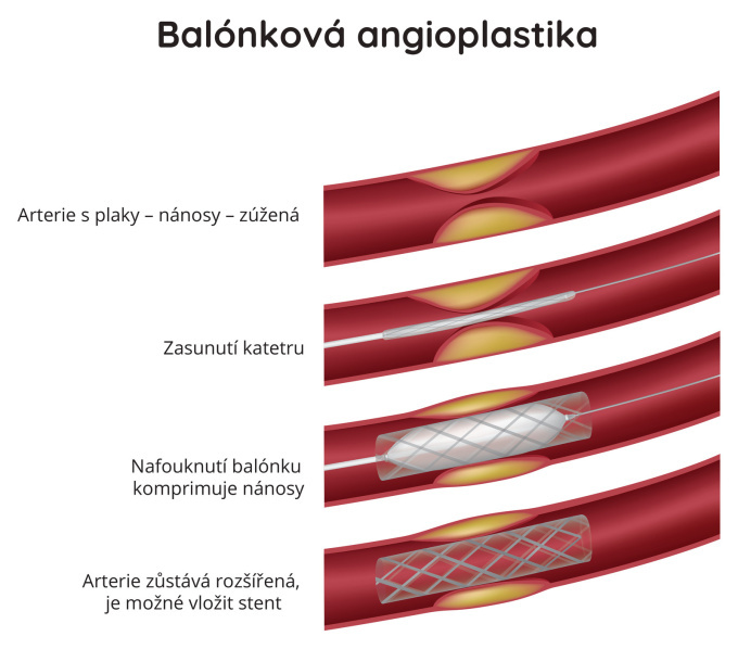 Balónková angioplastika