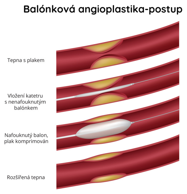 Balónková angioplastika - postup