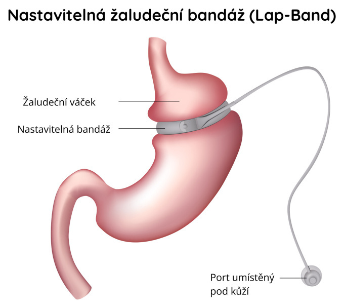 Bandáž žaludku