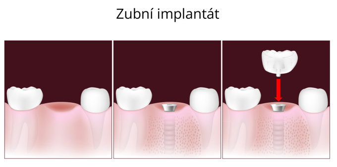Dentální (zubní) implantát, umělá náhrada vlastního zubu