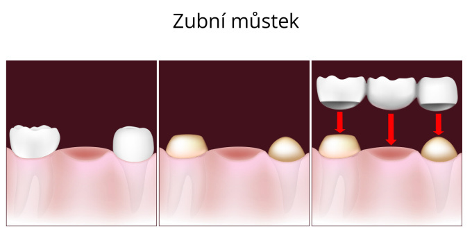 Dentální (zubní) můstek, částečná zubní náhrada