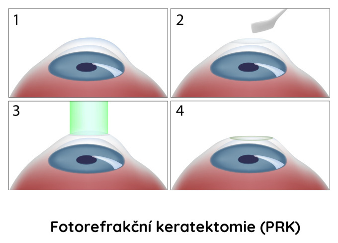 operace PRK (fotorefrakční keratektomie)
