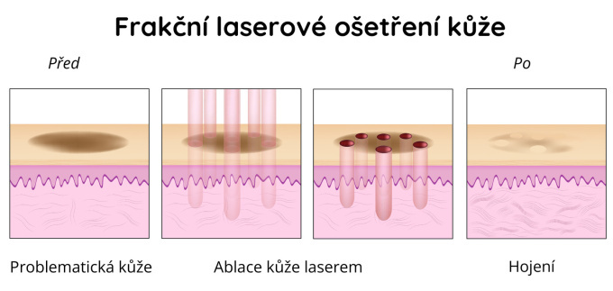 Frakční laserový hojivý kožní zákrok