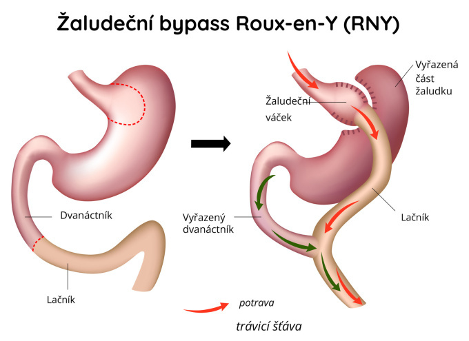 Resekce typu Roux-en-Y