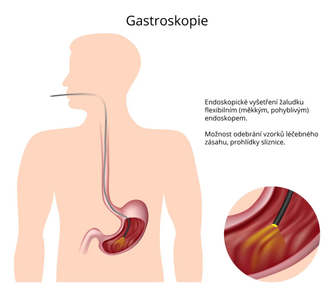 Gastroskopie