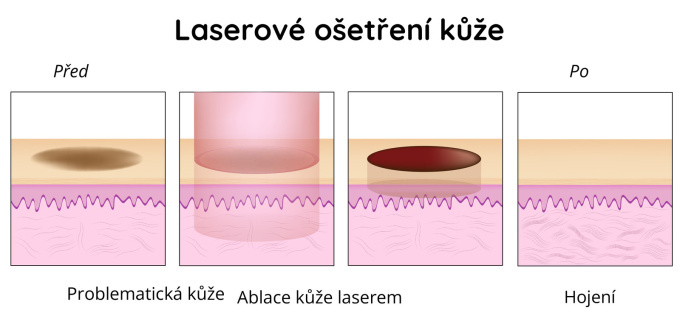 Hojení kůže pomocí laseru