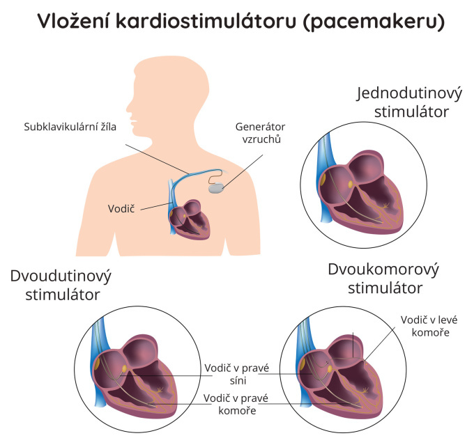 Vložení kardiostimulátoru (pacemakeru).