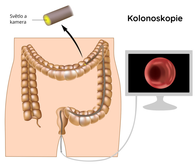 Kolonoskopie / koloskopie