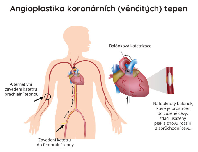 Angioplatika koronarnich (věnčitých) tepen