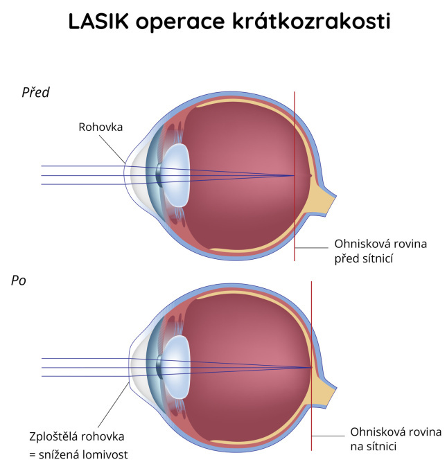 Laserová operace krátkozrakosti (myopie) - LASIK