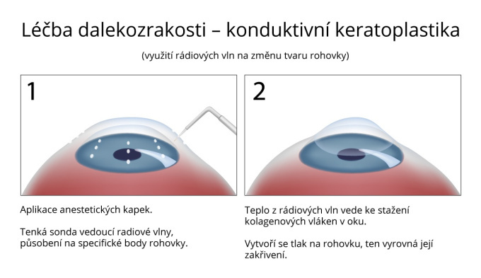 Konduktivní keratoplastika - léčba-dalekozrakosti