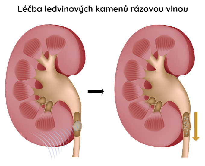 Léčba ledvinových kamenů rázovou vlnou
