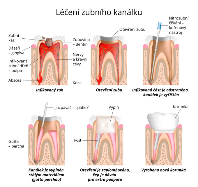 Léčení zubního kanálku, výplň, čep a korunka