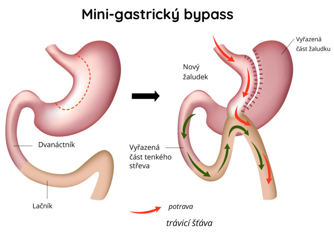 Mini gastrický bypass – přemostění obejití při léčbě obezity