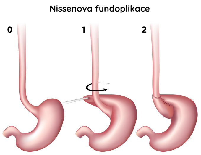 Nissenova fundoplikace