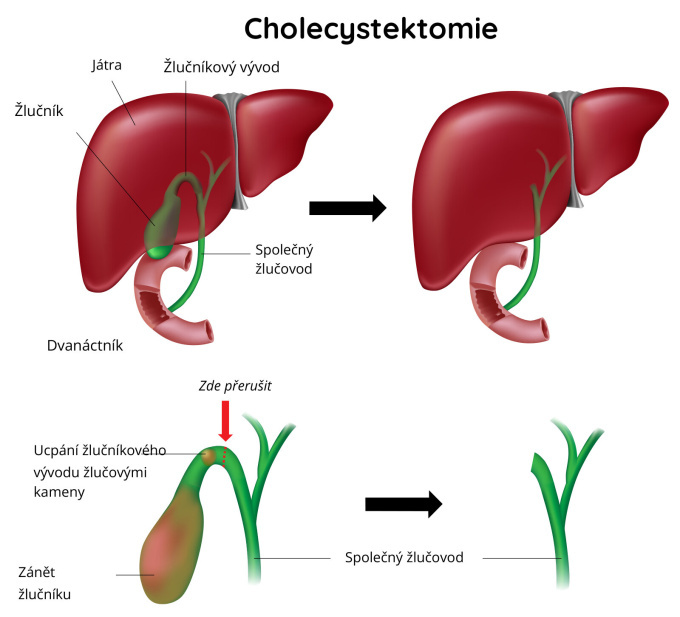 Cholecystektomie - odstranění žlučníku