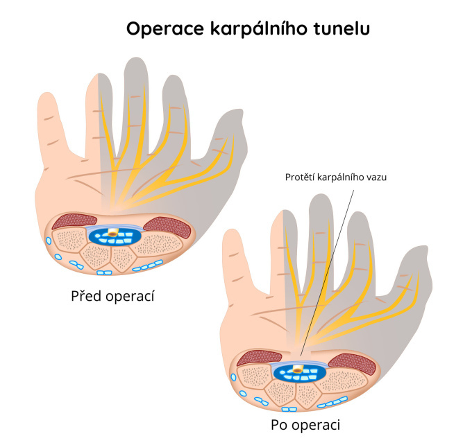 Operace karpalniho tunelu - protětí karpálního vazu