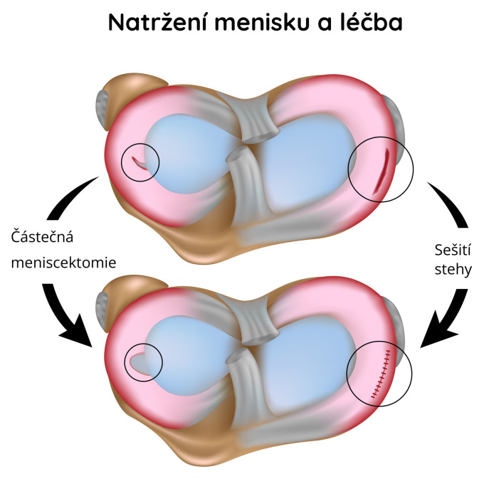 Natržený meniskus – operační léčba