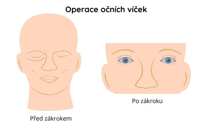 Operace očních víček