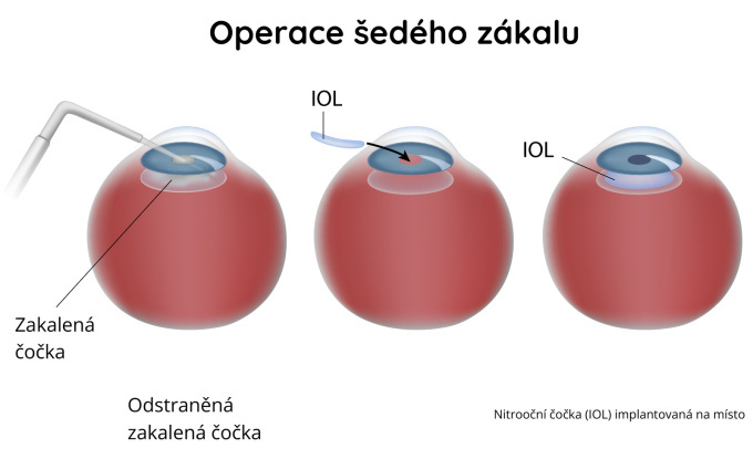 Operace šedého zákalu - katarakty