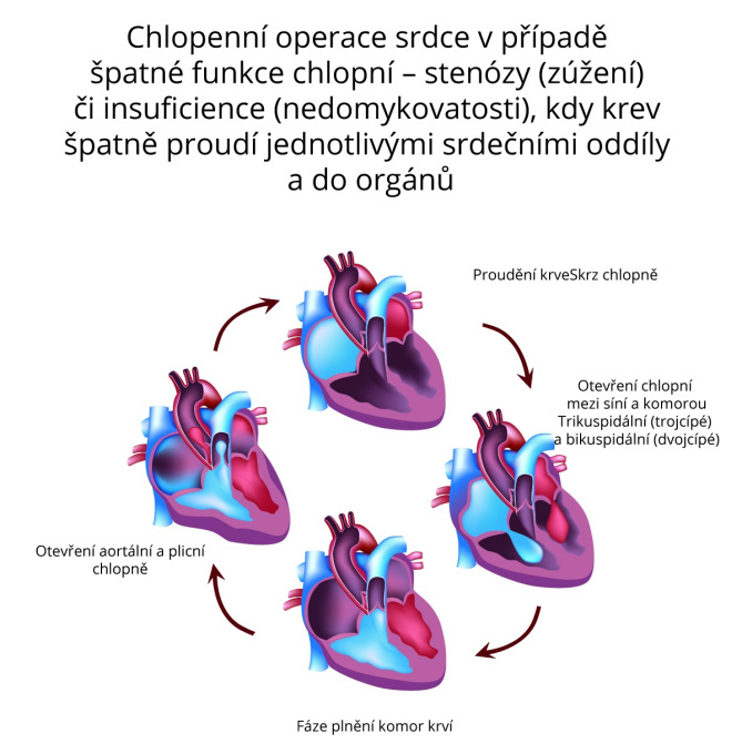 Chlopenní operace srdce
