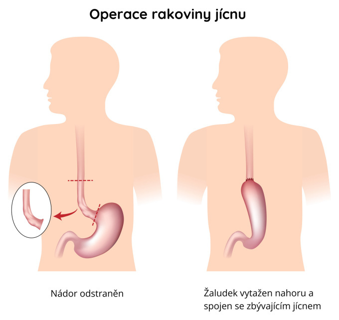 Chirurgické řešení rakoviny jícnu (ezofagu), resekce postižené části
