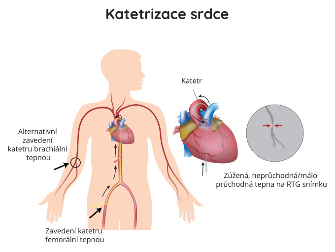 Katetrizace srdce