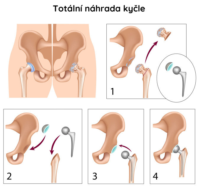Totální endoprotéza – celková náhrada kyčelního kloubu