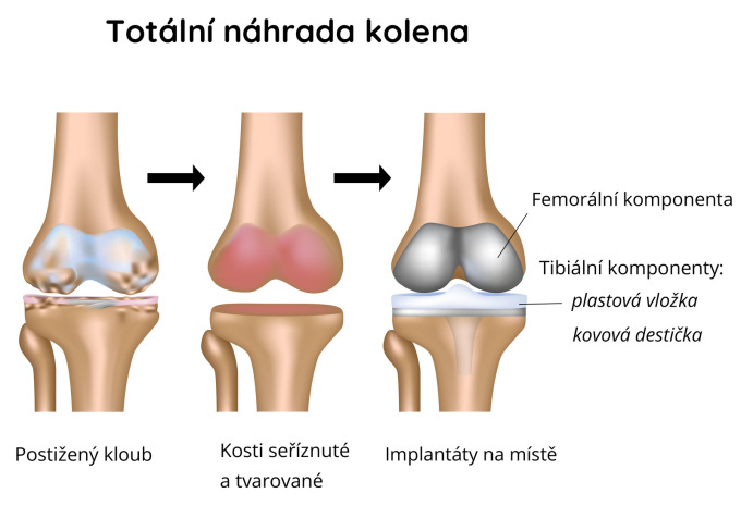 Totální náhrada kolenního kloubu u osteoartritidy