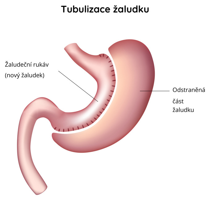 Tubulizace žaludku jako součást bariatrické léčby obezity