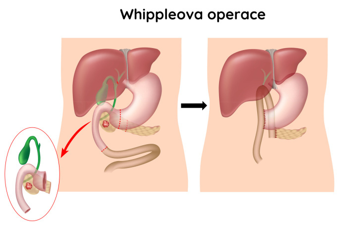Whippleho operace - částečné odstranění dvanáctníku a slinivky břišní