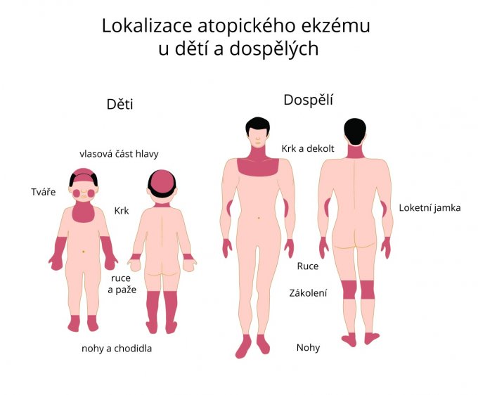 Lokalizace atopického ekzému u dětí a dospělých