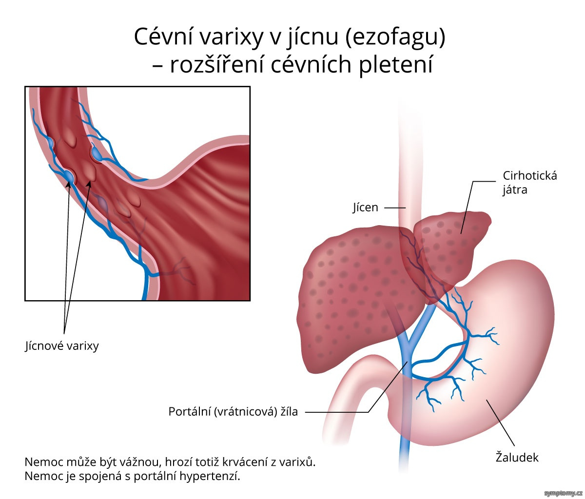 Cévní varixy v jícnu (ezofagu) – rozšíření cévních pletení
