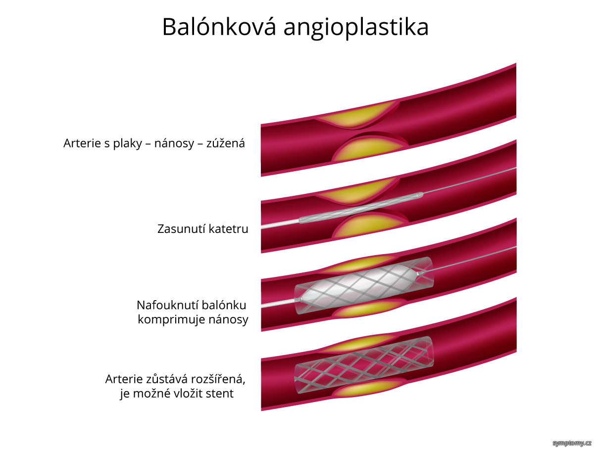 Balónková angioplastika